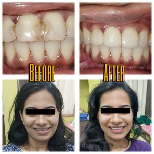 Ceramic Veneers | Results